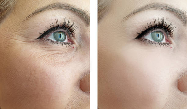 Before and after crow's feet reduction